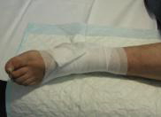 Photo06. Foot covered with bandage.