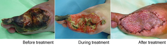 A case that healed by larval(maggot) therapy