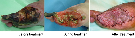 Maggot debridement therapy(larval therapy)