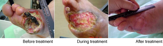 A case that healed by maggot(larval) therapy
