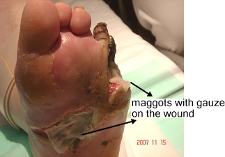 maggots with gauze on the wound